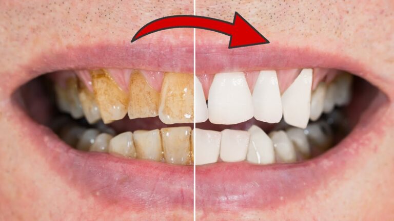 Des dents jaunes en 2 minutes : 5 astuces pour les rendre blanches et brillantes !