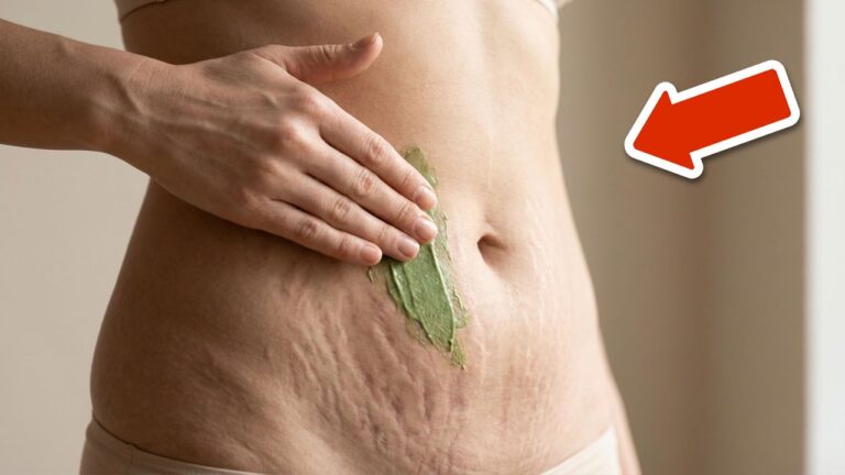 Éliminez les 5 types de vergetures rapidement et naturellement !