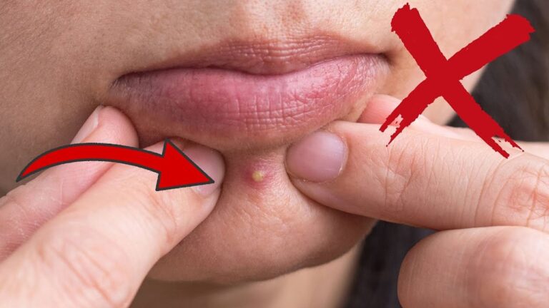 Évite ces 5 zones risquées pour presser un bouton et protège ta peau !